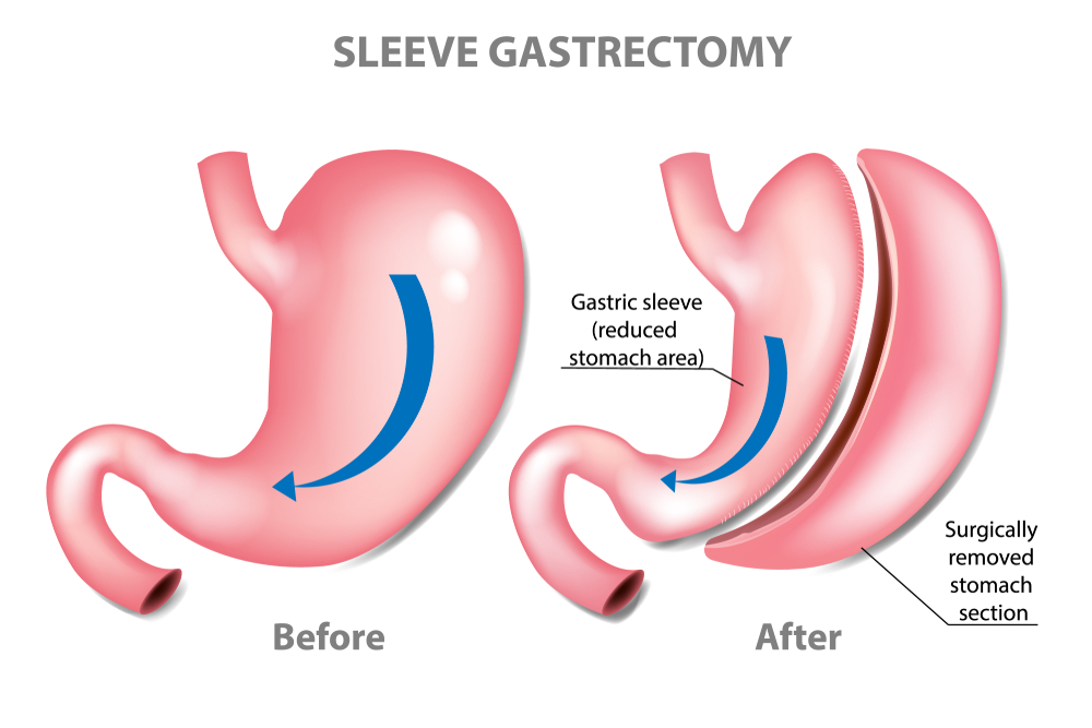 Explained, what is GASTRIC SLEEVE